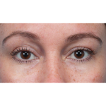 Lower Blepharoplasty Before & After Patient #3790