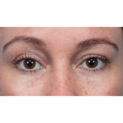 Lower Blepharoplasty Before & After Patient #3790