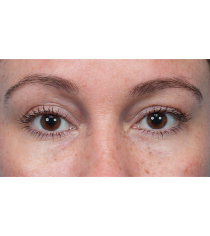 Lower Blepharoplasty Before & After Patient #3790