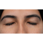 Upper Blepharoplasty Before & After Patient #3769