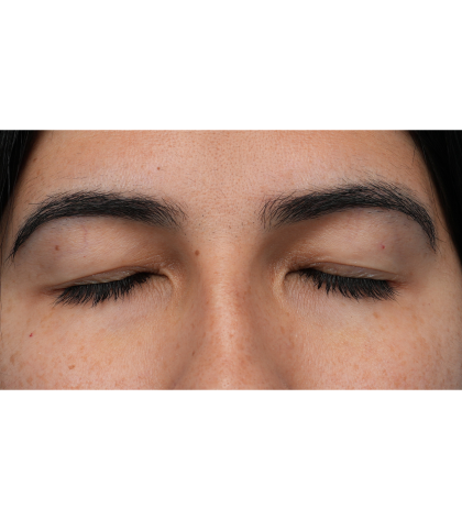 Upper Blepharoplasty Before & After Patient #3769