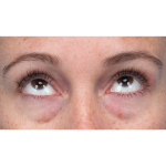 Lower Blepharoplasty Before & After Patient #3790
