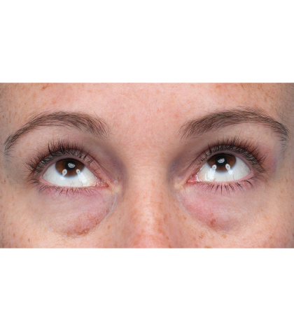 Lower Blepharoplasty Before & After Patient #3790