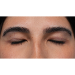 Upper Blepharoplasty Before & After Patient #3769