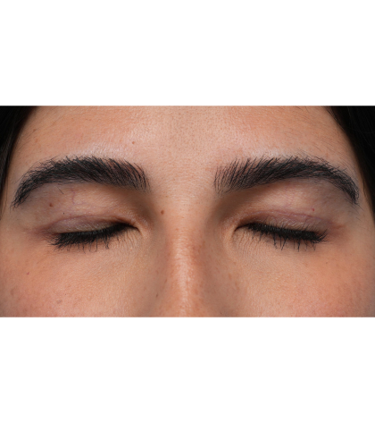 Upper Blepharoplasty Before & After Patient #3769