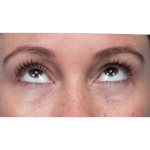 Lower Blepharoplasty Before & After Patient #3790