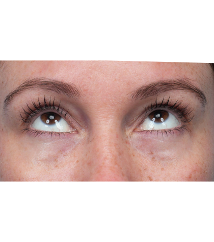 Lower Blepharoplasty Before & After Patient #3790
