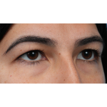 Upper Blepharoplasty Before & After Patient #3769