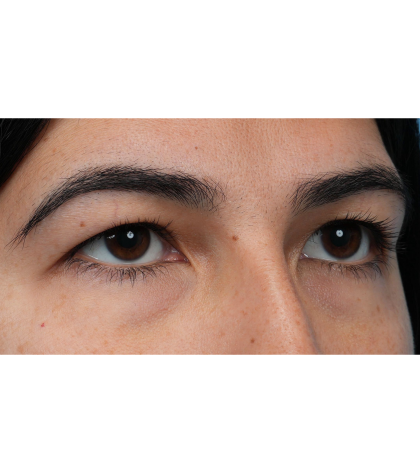 Upper Blepharoplasty Before & After Patient #3769