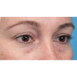 Lower Blepharoplasty Before & After Patient #3790