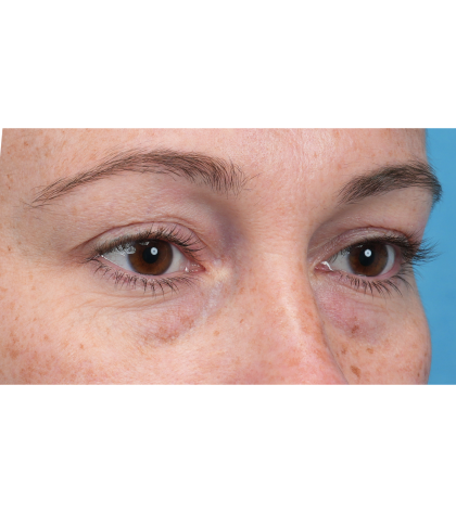 Lower Blepharoplasty Before & After Patient #3790