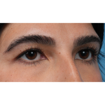 Upper Blepharoplasty Before & After Patient #3769