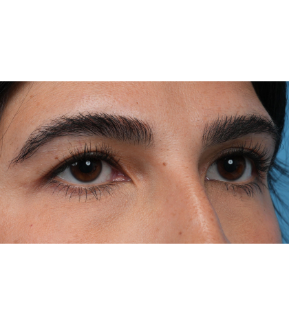 Upper Blepharoplasty Before & After Patient #3769