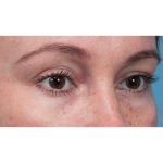 Lower Blepharoplasty Before & After Patient #3790