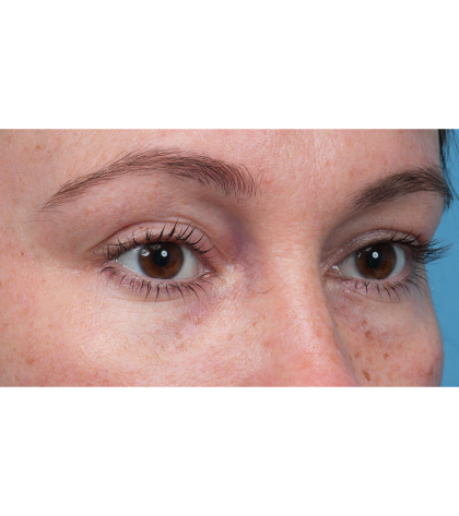 Lower Blepharoplasty Before & After Patient #3790