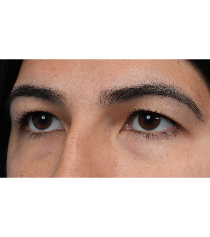 Upper Blepharoplasty Before & After Patient #3769