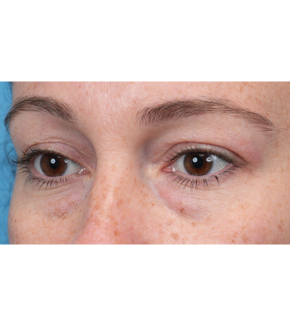Lower Blepharoplasty Before & After Patient #3790