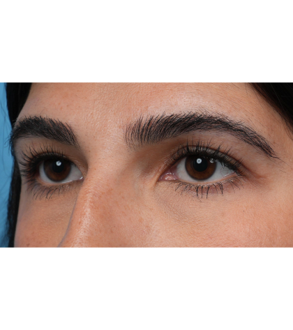 Upper Blepharoplasty Before & After Patient #3769