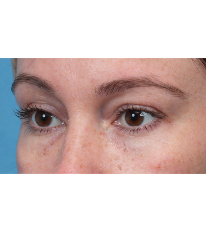 Lower Blepharoplasty Before & After Patient #3790