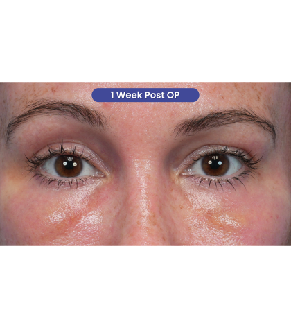 Lower Blepharoplasty Before & After Patient #3790