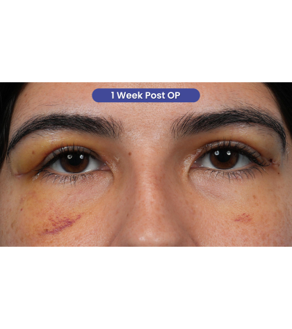 Upper Blepharoplasty Before & After Patient #3769