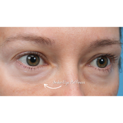 Ultra Clear Before & After Patient #3852