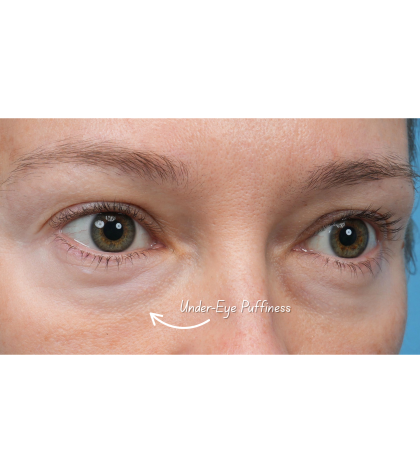 Ultra Clear Before & After Patient #3852