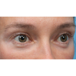 Ultra Clear Before & After Patient #3852