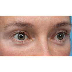 Ultra Clear Before & After Patient #3852