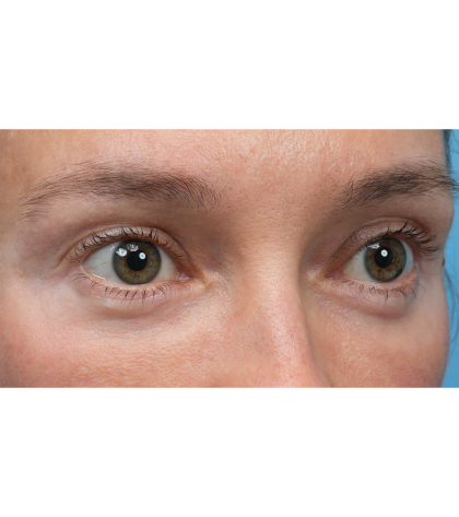 Ultra Clear Before & After Patient #3852
