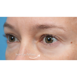 Ultra Clear Before & After Patient #3852
