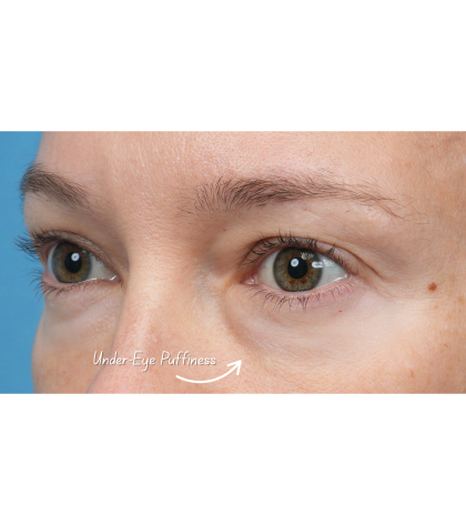 Ultra Clear Before & After Patient #3852