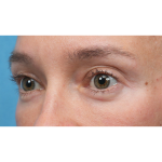 Ultra Clear Before & After Patient #3852