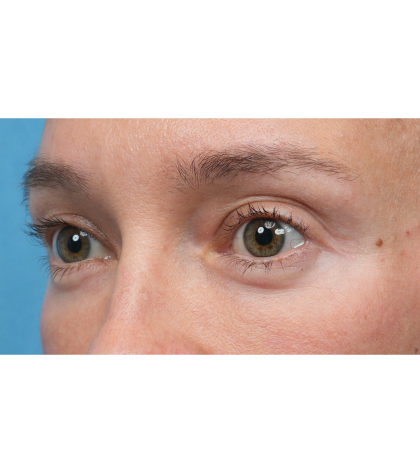 Ultra Clear Before & After Patient #3852
