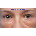 Ultra Clear Before & After Patient #3852