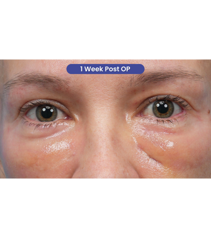 Ultra Clear Before & After Patient #3852