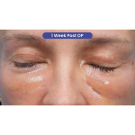 Ultra Clear Before & After Patient #3852