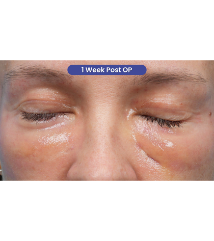 Ultra Clear Before & After Patient #3852