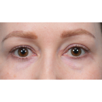 CO2 Laser Resurfacing Before & After Patient #3832