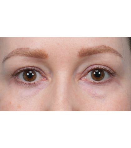 CO2 Laser Resurfacing Before & After Patient #3832