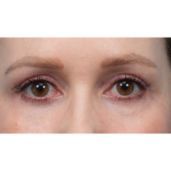 CO2 Laser Resurfacing Before & After Patient #3832