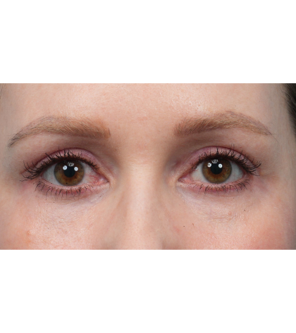 CO2 Laser Resurfacing Before & After Patient #3832