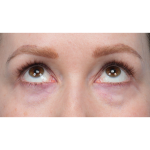 CO2 Laser Resurfacing Before & After Patient #3832