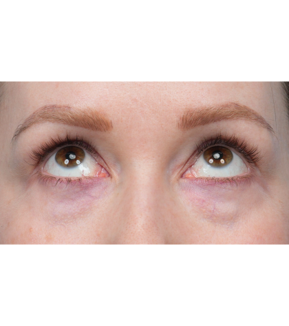 CO2 Laser Resurfacing Before & After Patient #3832