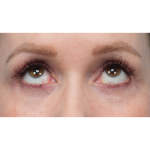 CO2 Laser Resurfacing Before & After Patient #3832
