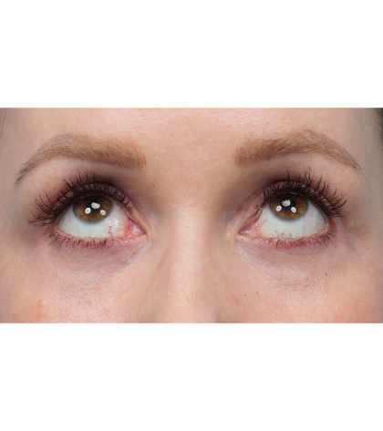 CO2 Laser Resurfacing Before & After Patient #3832