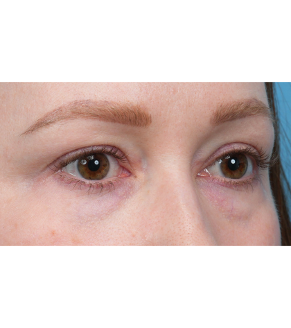 CO2 Laser Resurfacing Before & After Patient #3832