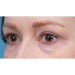 CO2 Laser Resurfacing Before & After Patient #3832