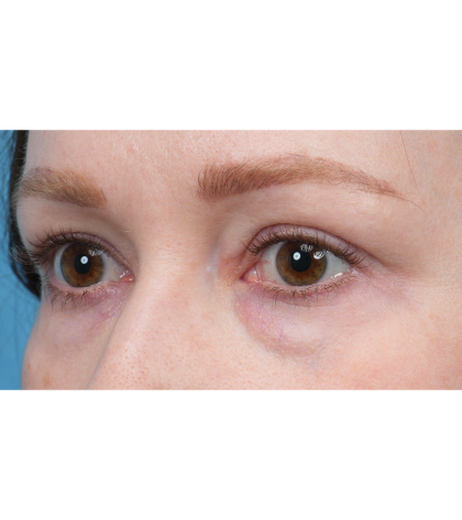 CO2 Laser Resurfacing Before & After Patient #3832