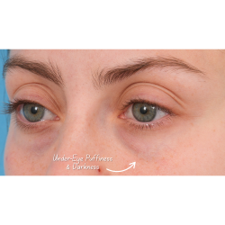 Tixel Before & After Patient #3841